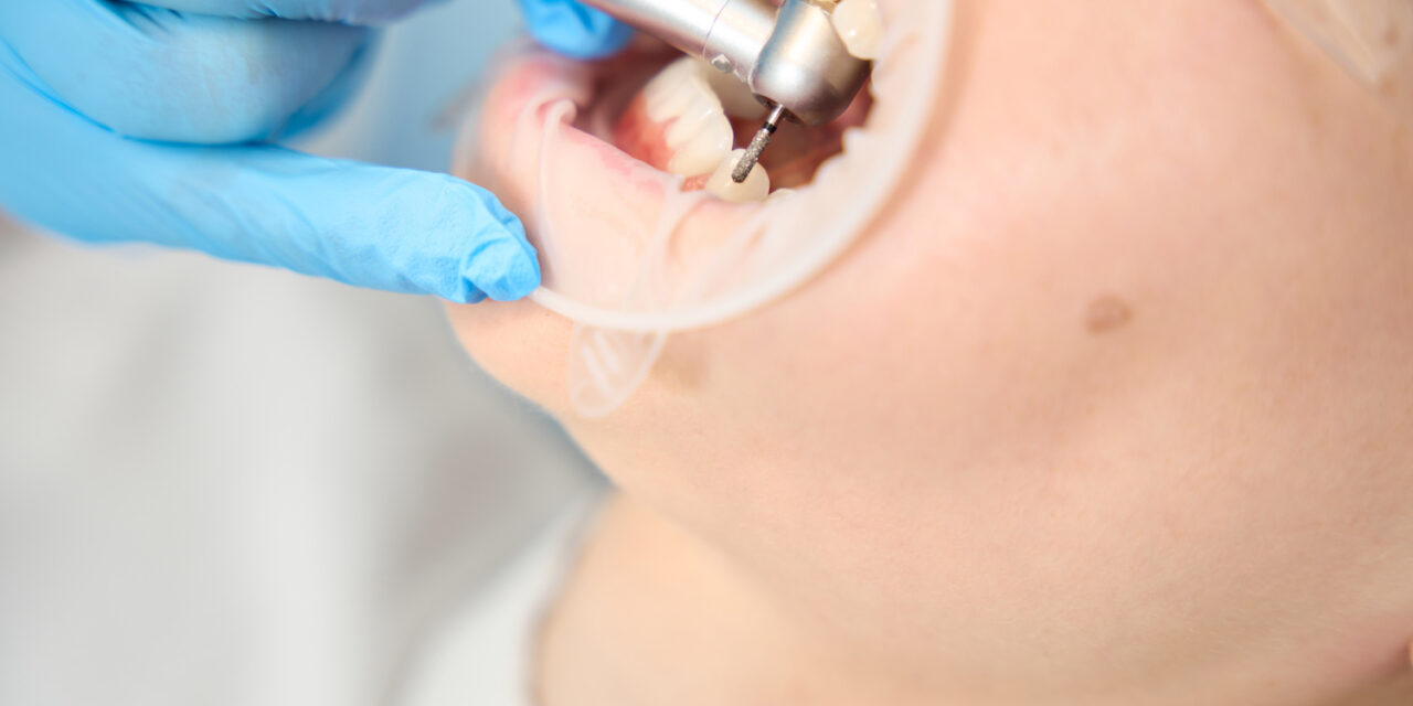 Diş Taşı (Dental Kalkülüs) Oluşumunun Önlenmesi Mümkün müdür?