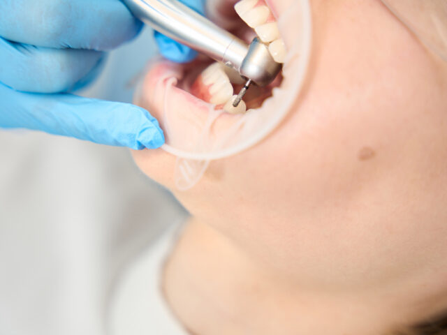 Diş Taşı (Dental Kalkülüs) Oluşumunun Önlenmesi Mümkün müdür?