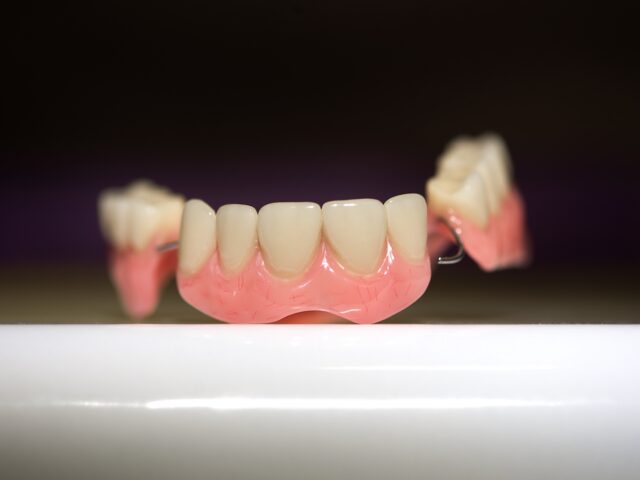 Diş İmplantı veya Diş Protezinde Kaç Dişe Kadar Köprü Yapılabilir?