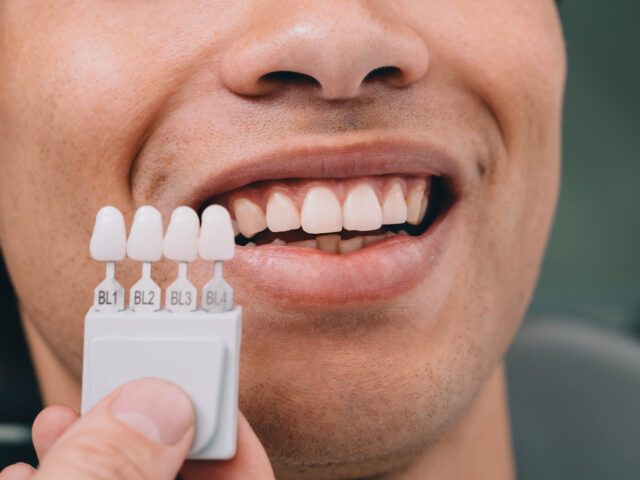 Porselen Lamine Gülüş Tasarımı Nedir?