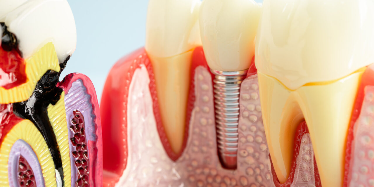 Diş İmplantı Sonrası Süreç Nasıl İlerler?