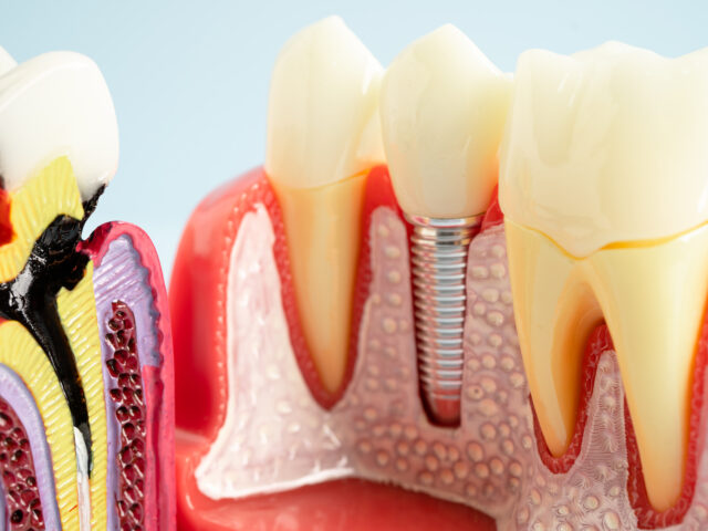 Diş İmplantı Sonrası Süreç Nasıl İlerler?