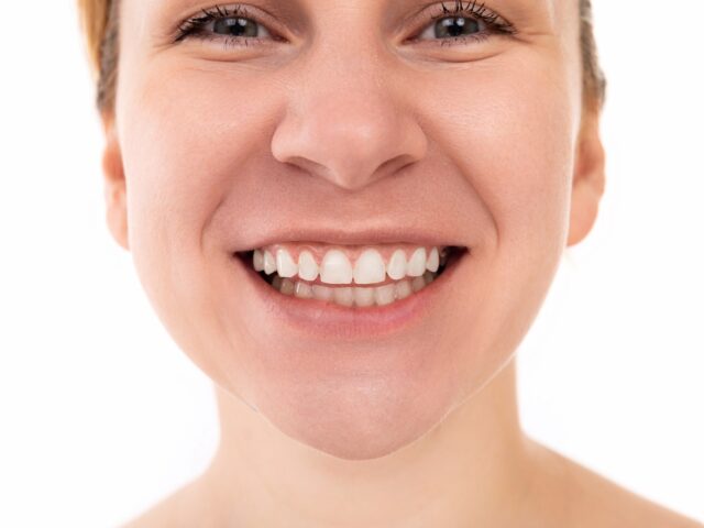 Diş Kaplama ve Gülüş Tasarımında Merak Edilenler