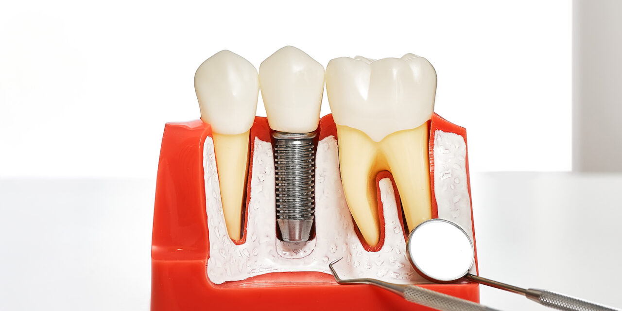 Diş İmplantı Tedavisinde Doku Sağlığı ve Hijyenin Belirleyici Rolü