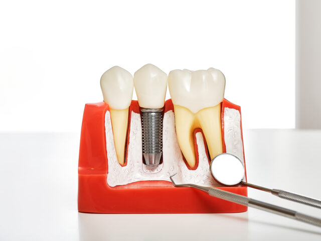 Diş İmplantı Tedavisinde Doku Sağlığı ve Hijyenin Belirleyici Rolü