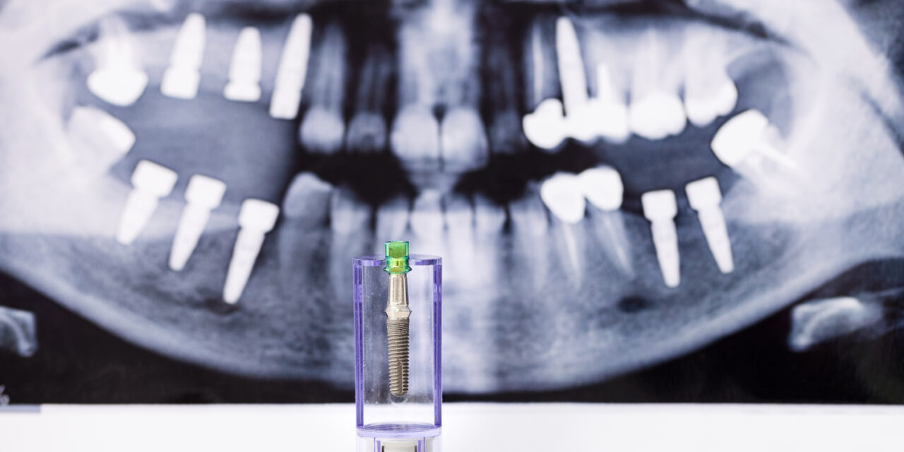 Diş İmplantı Süreci Nasıl İlerler?