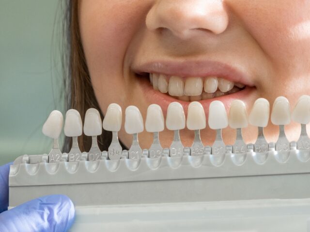 Gülüş Tasarımı Sürecinde Hangi Tedaviler Kullanılır?