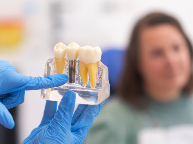 İmplant Diş Kullananlar Nelere Dikkat Etmeli?