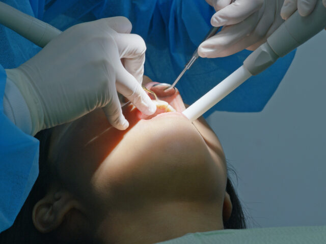 Diş Taşı Temizliği Neden Bir Lüks Değil, Temel Bir Zorunluluktur? Sessiz Tehlikeyi Anlamak