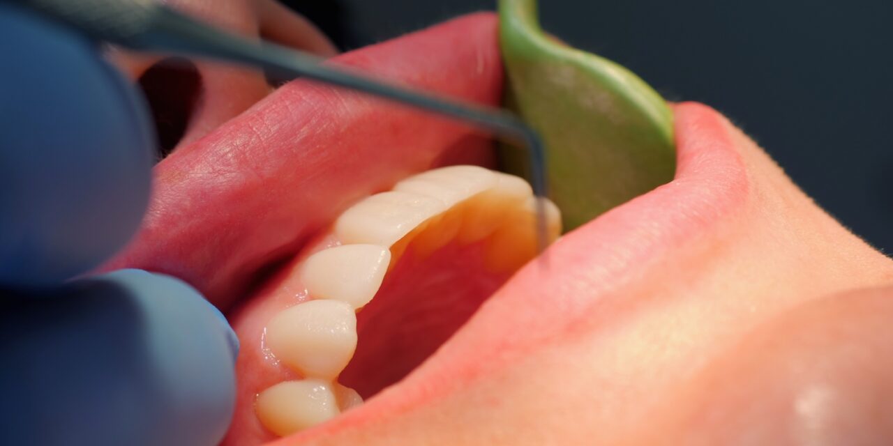 İleri Derece Periodontitis Tedavisinde Lazer Destekli Derin Doku Temizliği ve Kemik Rejenerasyonu