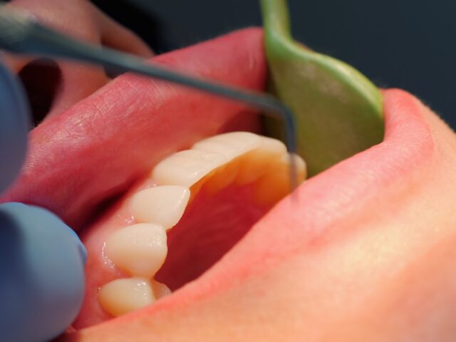 İleri Derece Periodontitis Tedavisinde Lazer Destekli Derin Doku Temizliği ve Kemik Rejenerasyonu